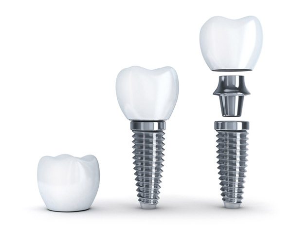 Dental Implants in River Forest, Berwyn, La Grange, West Loop & Elmhurst