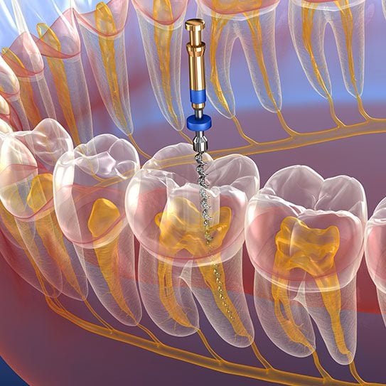 root canal Chicago root canals La Grange