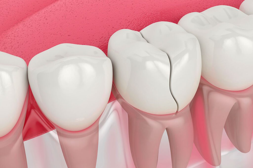cracked teeth, dental Elmhurst