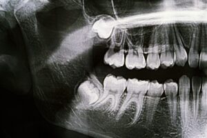 oral surgeon in elmhurst wisdom teeth