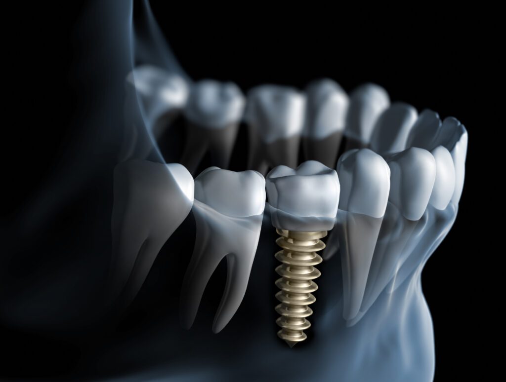 dental implants berwyn
