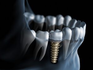 dental implants berwyn