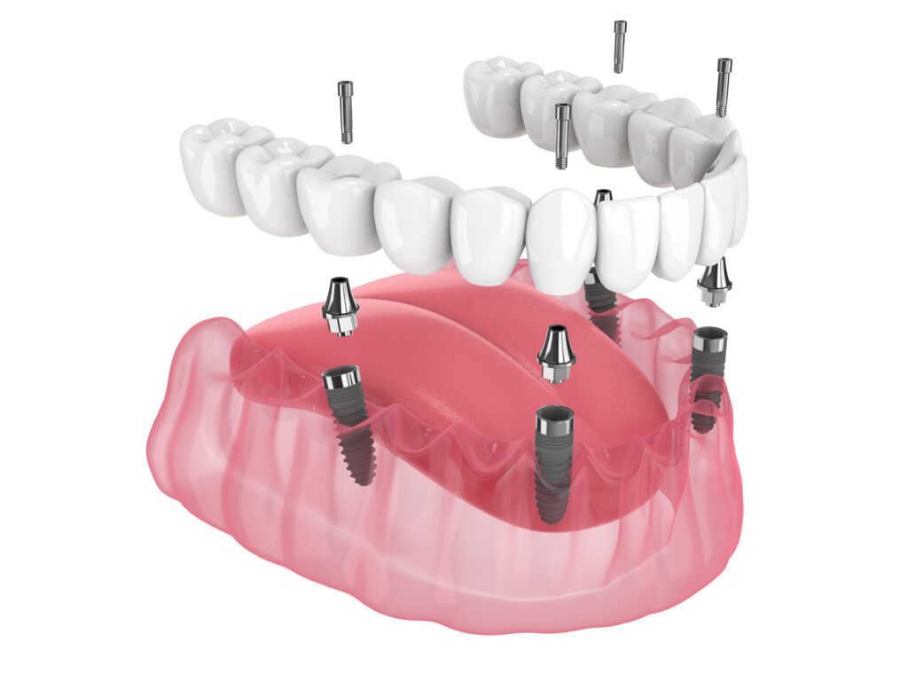 all-on-4 West Loop all-on-4 dental implants
