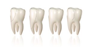 cracked tooth chicago, cracked tooth