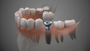 dental implants West Loop