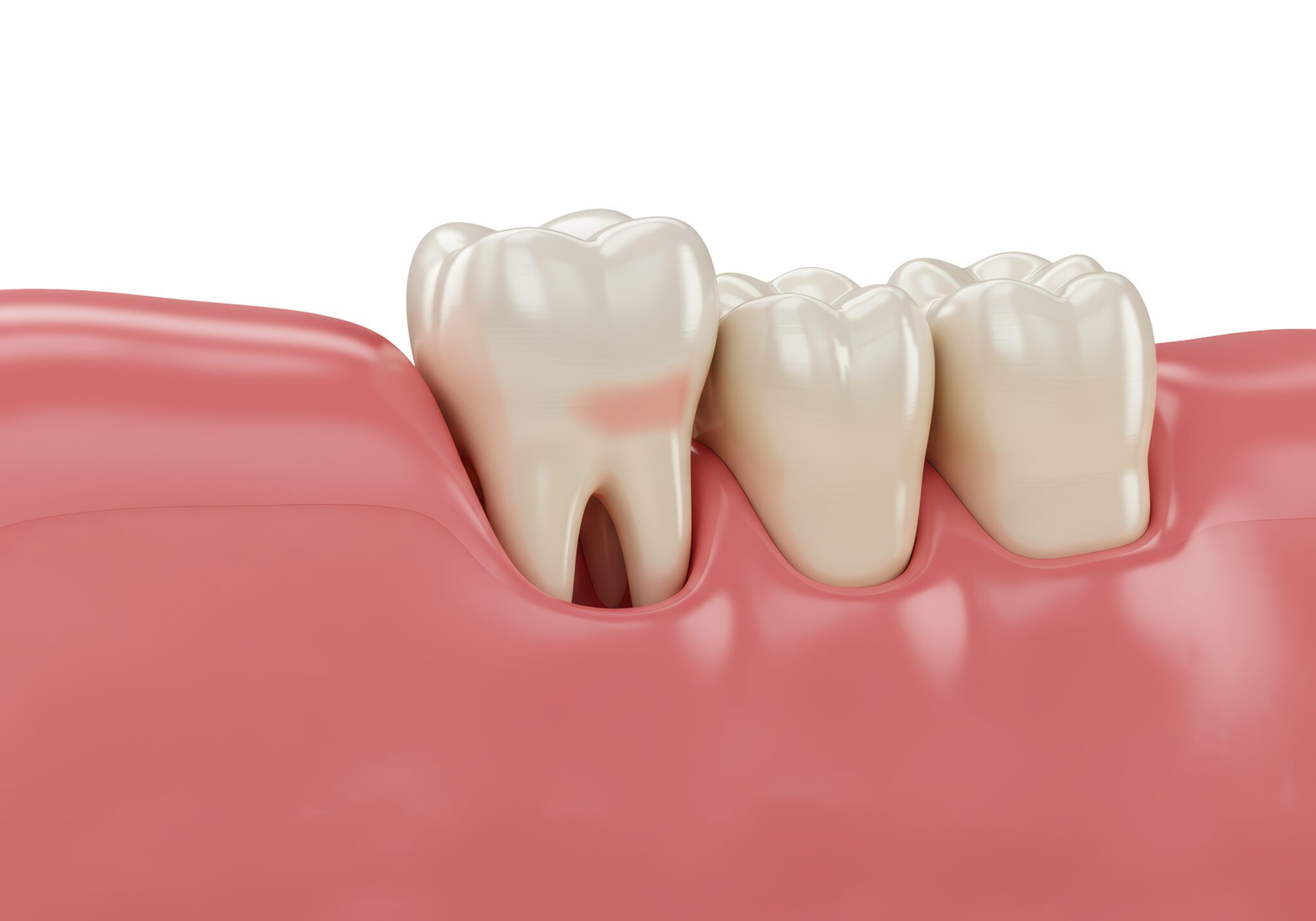 wisdom teeth removal in River Forest